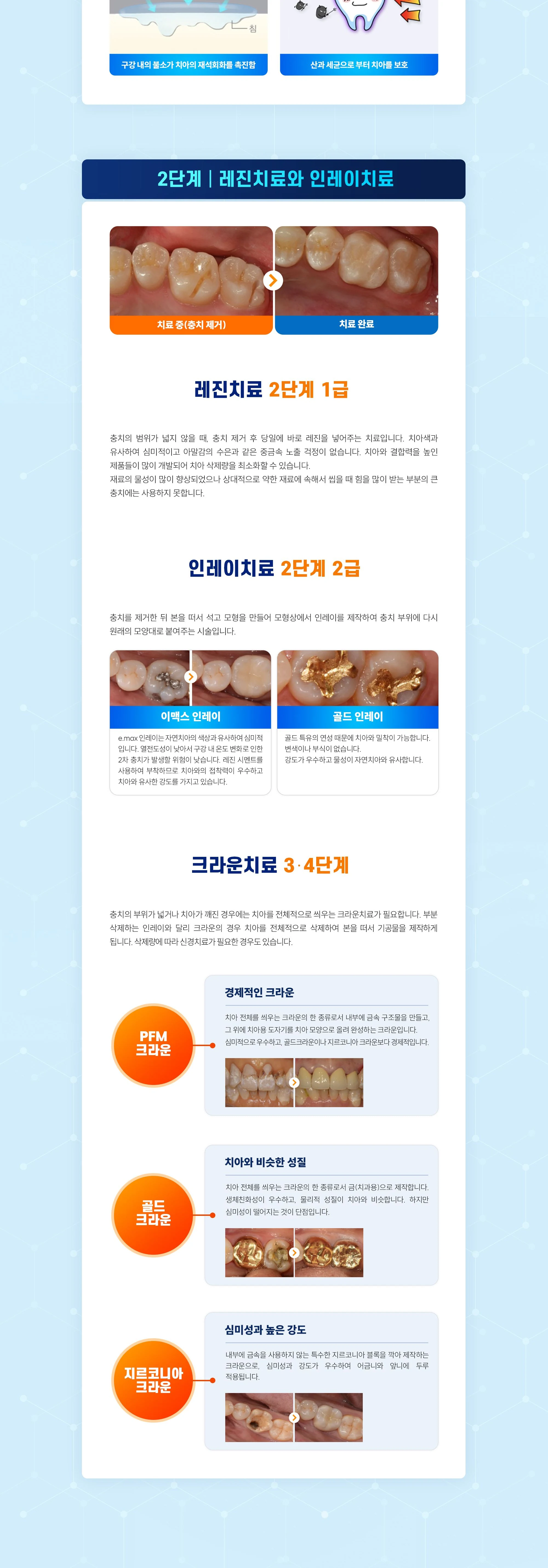 충치 치료 상세 안내 이미지 2